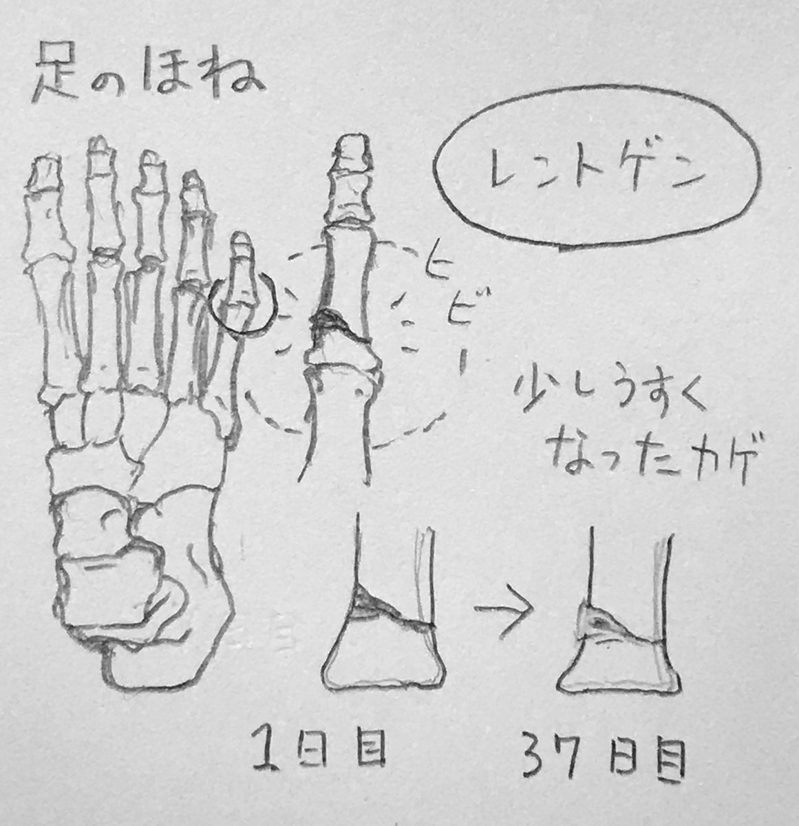 昨日はレントゲンでした?
骨の黒い影が薄くなってきた!
内出血も完全になくなって痛みも徐々に消えてってる感じ。家の中ならギブス外して良いよって言われたけど、事件は家の中で起きたのでつけてましゅと言ったら爆笑された。順調順調? 