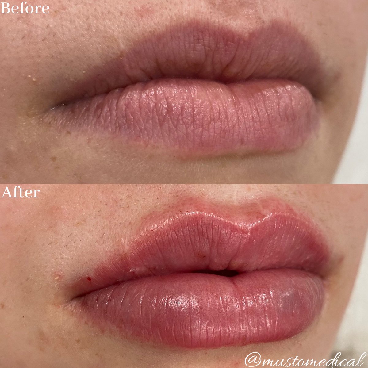 MustoMedical's tweet photo. Beautification with 1 syringe Restylane Defyne💉👄 https://t.co/2dSnzju2Zx