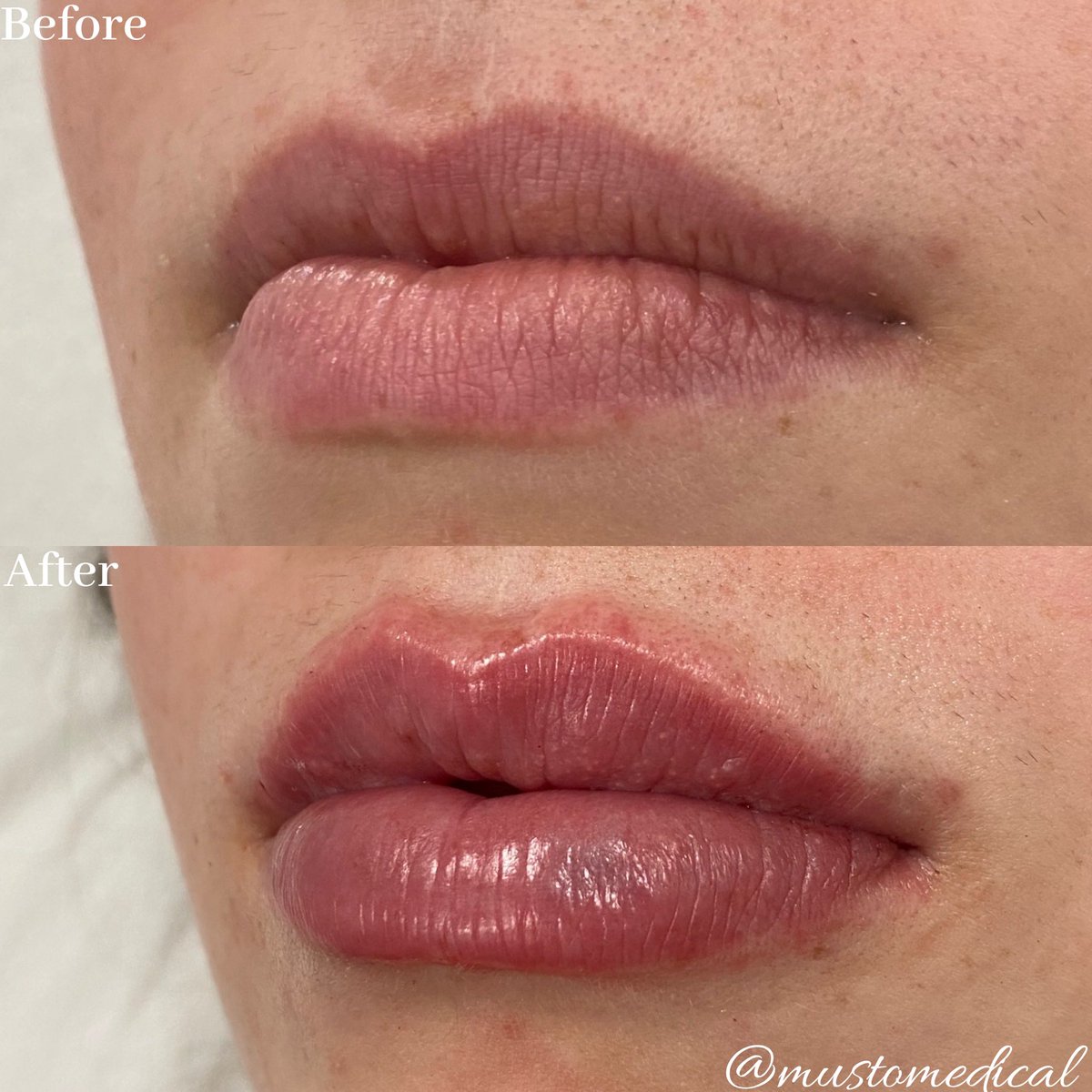 MustoMedical's tweet photo. Beautification with 1 syringe Restylane Defyne💉👄 https://t.co/2dSnzju2Zx