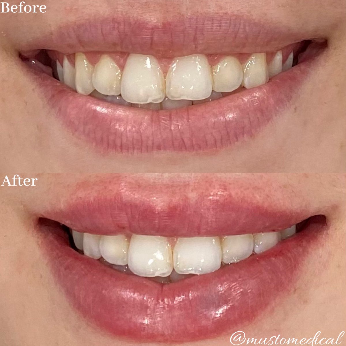 MustoMedical's tweet photo. Beautification with 1 syringe Restylane Defyne💉👄 https://t.co/2dSnzju2Zx