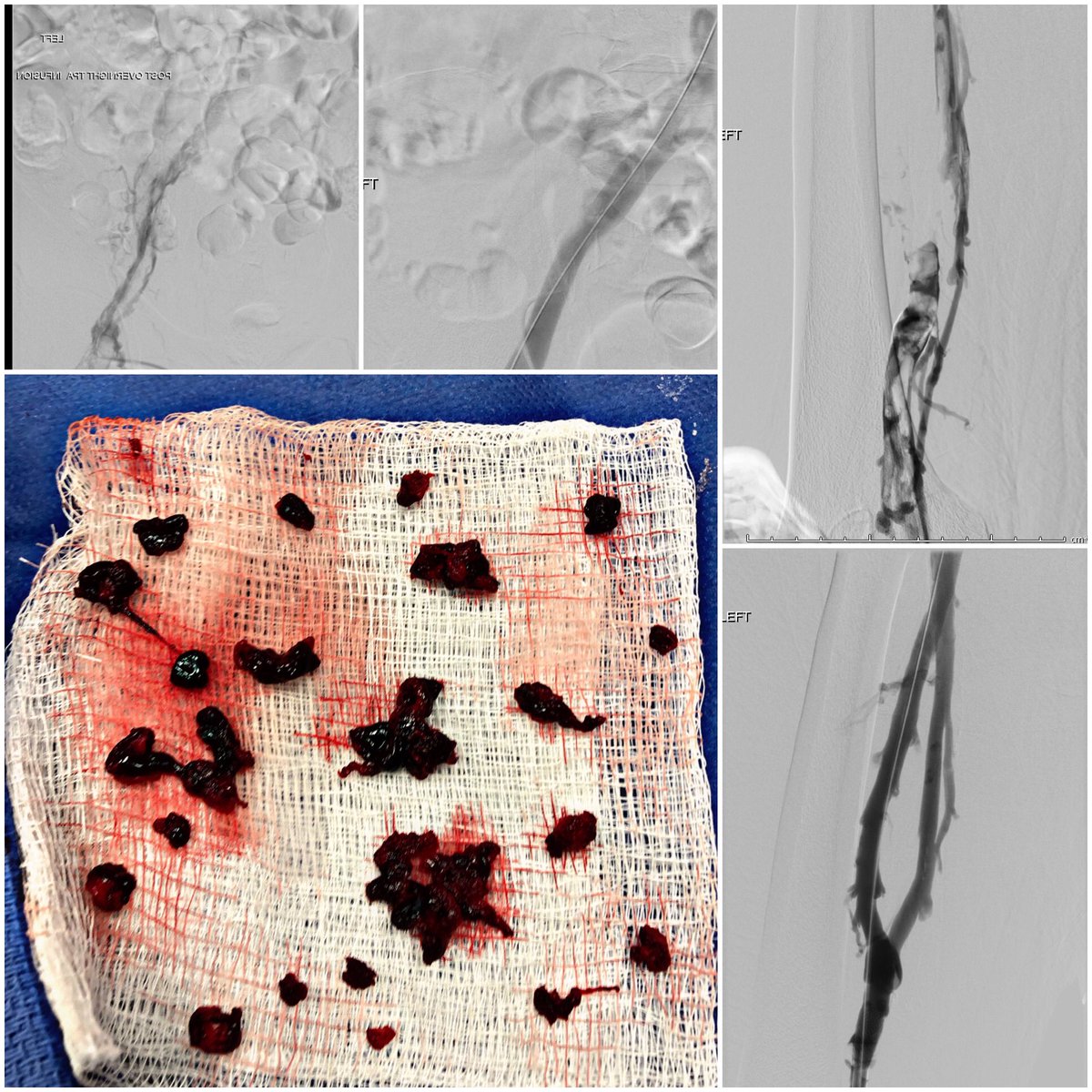 D Jilani (@drjnotjulius) on Twitter photo Phlegmasia cerulea dolens with extensive left leg acute DVT and concurrent May-Thurner syndrome. Treated with CDT and mechanical thrombectomy (<a href="/InariMedical/">Inari, now part of Stryker</a>). Iliac vein stented with <a href="/MedtronicAPV/">MedtronicAPV</a> Abre venous stent. Near immediate improvement. Phlegmasia cerulea dolens with extensive left leg acute DVT and concurrent May-Thurner syndrome. Treated with CDT and mechanical thrombectomy (<a href="/InariMedical/">Inari, now part of Stryker</a>). Iliac vein stented with <a href="/MedtronicAPV/">MedtronicAPV</a> Abre venous stent. Near immediate improvement.