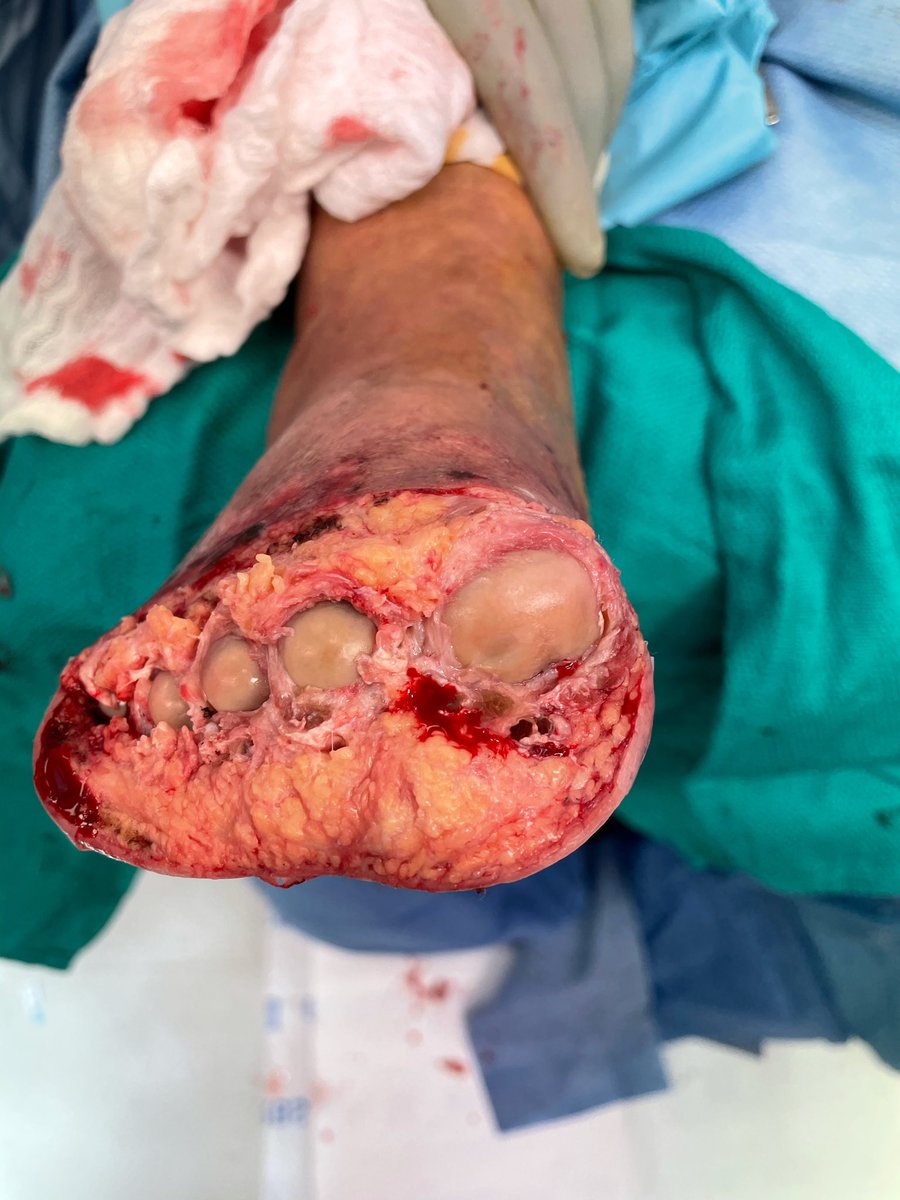 CLTI arterializations should be left alone for a minimum of 6-8 weeks before any Podiatric intervention. The only 2 drivers for early pod intervention are pain or infection, in which case we like keeping the met cartilage as a protector barrier against osteo.   Thoughts on this?