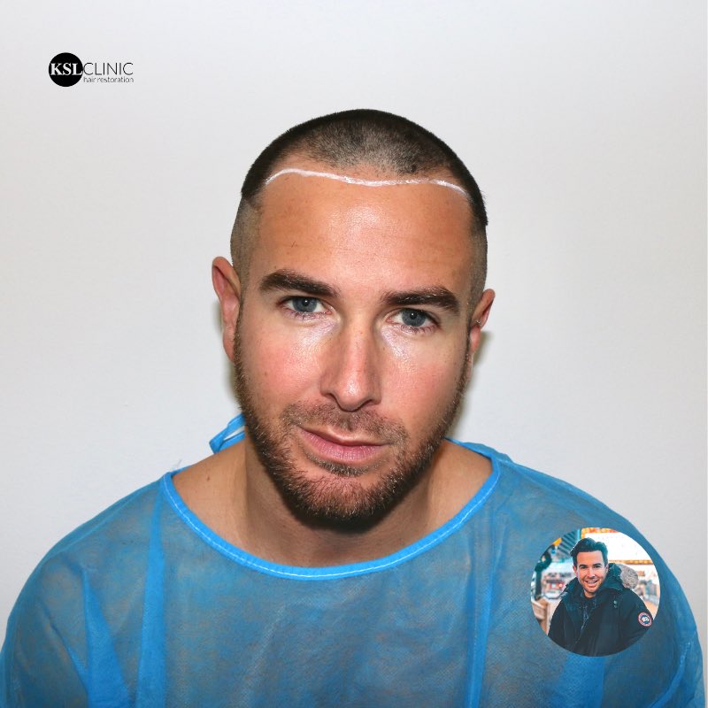 KSL_Clinics's tweet photo. 𝐎𝐧𝐞 𝐘𝐞𝐚𝐫 𝐂𝐥𝐮𝐛 ✂️🔥
🤟🏽 Check out Aaron Renfree’s (@AaronRenfree) hairline AND crown transformation! 12 Months after his FUE Hair Transplant at KSL Clinic.
#KSLClinic #DrMatee #FUE #CrownTransplant #HairTransplant #AaronRenfree #AaronRenfreeHairTransplant https://t.co/87HsTBcHlx