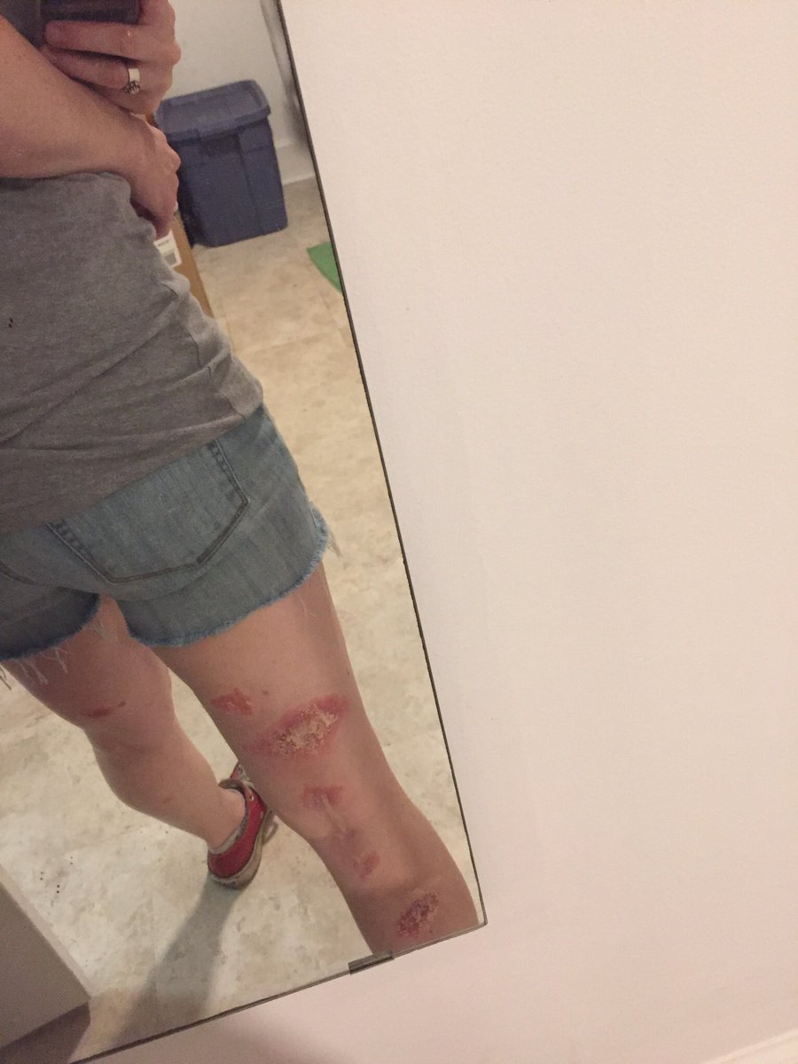 RachMakesCakes's tweet photo. @tpwky This was me in 2017. I am legit terrified of plants now and will only do yard work if I’m covered head to toe! https://t.co/nUNNwJhonL