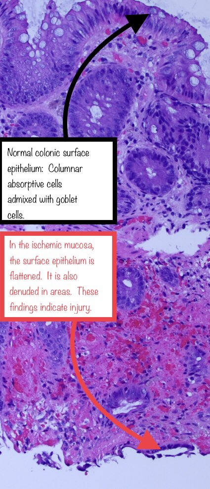  #GIpath Injury Patterns 101Interesting slide which shows an area of ischemic colitis next to an area of normal colon mucosa.I thought this was a nice opportunity to show the features of ischemic colitis.Added some annotations, which may be helpful to those starting out.