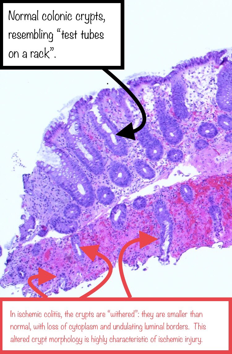 Second image from:  https://pubmed.ncbi.nlm.nih.gov/29177895/&nbsp;