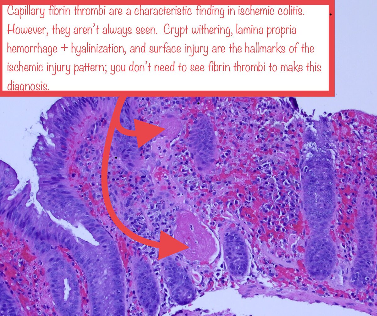 Second image from:  https://pubmed.ncbi.nlm.nih.gov/29177895/&nbsp;