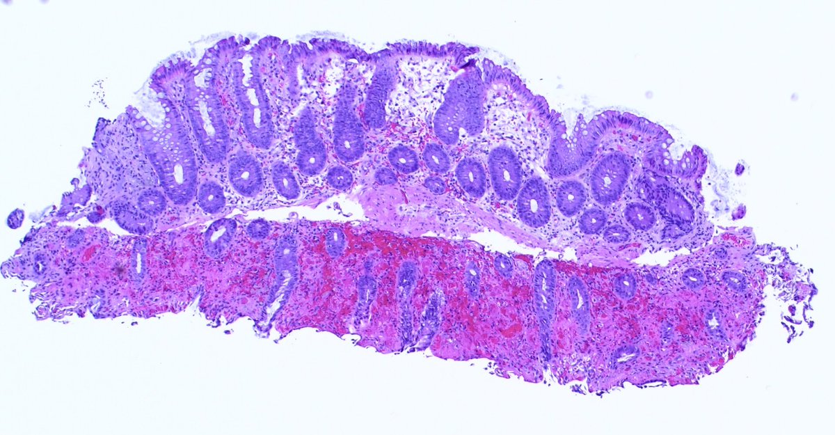  #GIpath Injury Patterns 101Interesting slide which shows an area of ischemic colitis next to an area of normal colon mucosa.I thought this was a nice opportunity to show the features of ischemic colitis.Added some annotations, which may be helpful to those starting out.