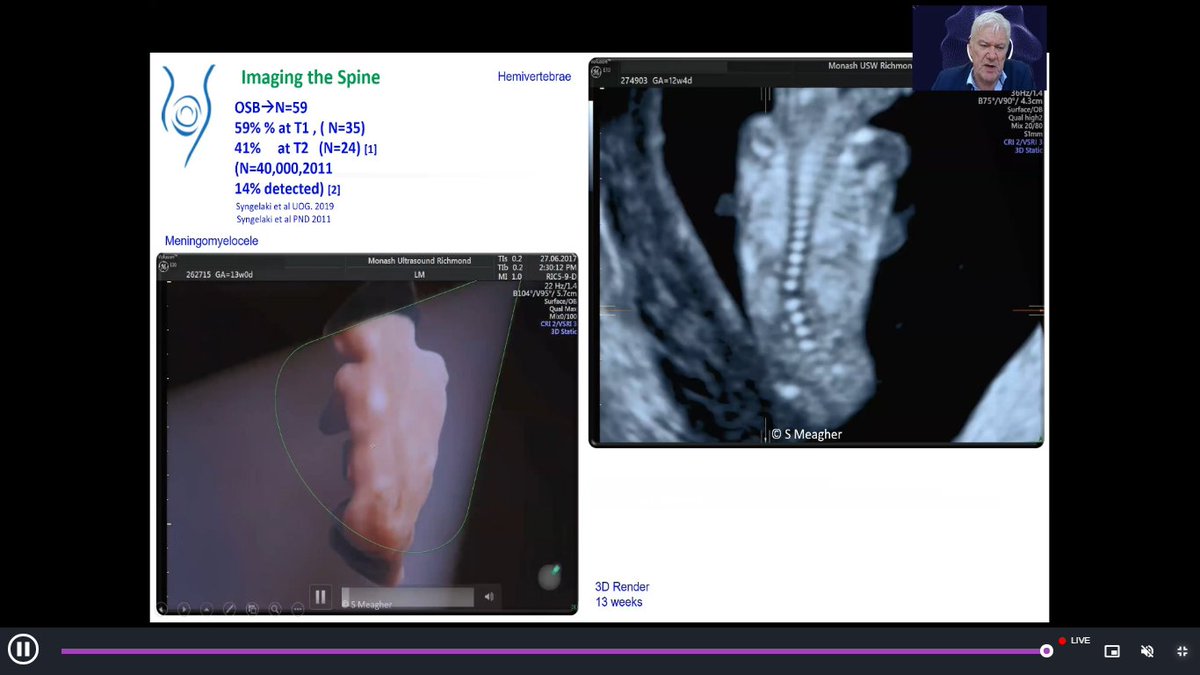Simon Meagher presenting on detecting abnormalities on a scan in the first trimester at the APAC session of #ISUOGat30 free education webinar, chaired by <a href="/GeorgeCondous/">Professor George Condous</a>  @cylpoon1   #LoveUltrasound #ISUOG