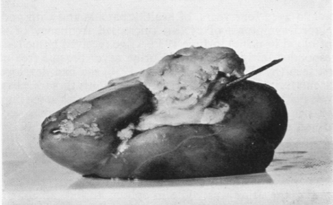 thomasngmorris's tweet photo. Incredibly, in the girl's right kidney! After she swallowed it, the hair clip came to rest in the duodenum. After some time it punctured the wall and entered the kidney the renal pelvis - leaving both kidney and duodenum impaled. Surgeons removed the kidney with hairclip visible. https://t.co/6fcZvk7FMc
