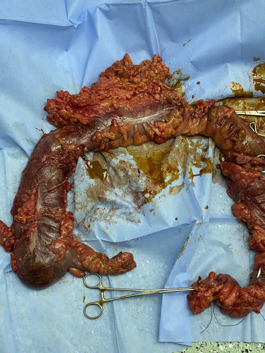 Emergency total colectomy