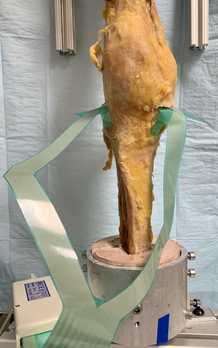 jondickensmd's tweet photo. #SundayFunday with @Walter ReedOrtho doing some #ACL #Biomechanics #Tekscan @MelHelgesonMD @ChrisTuckerMD @scottwagnermd @LeAnthony_BioE @tcola55 https://t.co/8M6Ekf9LhB