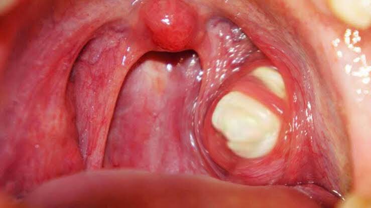 subpharmacist's tweet photo. THREAD: Tonsilitis Vs Tonsil stones

What is the difference and what you need to know:

RT to help someone https://t.co/W86tABtXGR