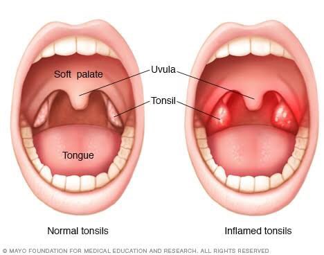 subpharmacist's tweet photo. THREAD: Tonsilitis Vs Tonsil stones

What is the difference and what you need to know:

RT to help someone https://t.co/W86tABtXGR