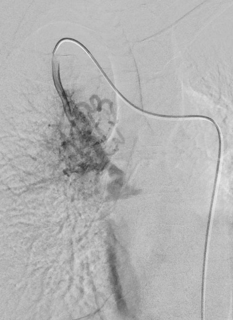 Weill Cornell Medicine Interventional Radiology (@weillcornell_ir) on Twitter photo Young patient presenting with hemoptysis. Found to have new lymphoma with arterial extrav into a RUL bronchus on CTA. Time for angio and embo to control bleeding with super fellow <a href="/JesseChenMD/">Jesse Chen</a> ! 3 sources visualized on angio with probably shunt from IMA. Young patient presenting with hemoptysis. Found to have new lymphoma with arterial extrav into a RUL bronchus on CTA. Time for angio and embo to control bleeding with super fellow <a href="/JesseChenMD/">Jesse Chen</a> ! 3 sources visualized on angio with probably shunt from IMA.