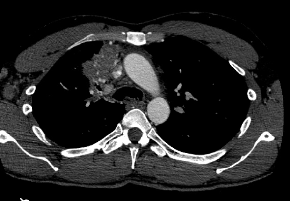 WeillCornell_IR's tweet photo. Young patient presenting with hemoptysis. Found to have new lymphoma with arterial extrav into a RUL bronchus on CTA. Time for angio and embo to control bleeding with super fellow @JesseChenMD ! 3 sources visualized on angio with probably shunt from IMA. https://t.co/cORQ4aTkzX