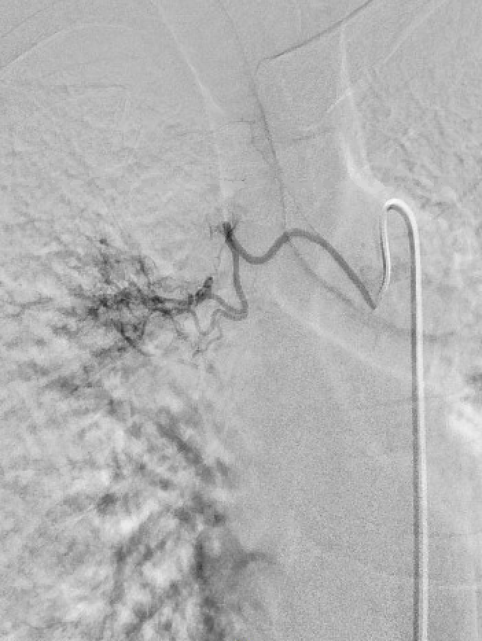WeillCornell_IR's tweet photo. Young patient presenting with hemoptysis. Found to have new lymphoma with arterial extrav into a RUL bronchus on CTA. Time for angio and embo to control bleeding with super fellow @JesseChenMD ! 3 sources visualized on angio with probably shunt from IMA. https://t.co/cORQ4aTkzX
