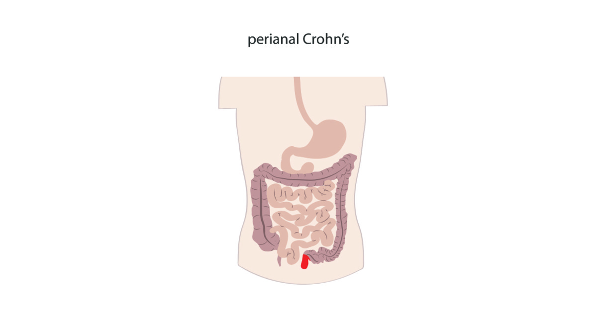 ibdrelief's tweet image. Perianal #Crohnsdisease is a form of Crohn&apos;s which affects the anus - ibdrelief.com/learn/what-is-… #IBD