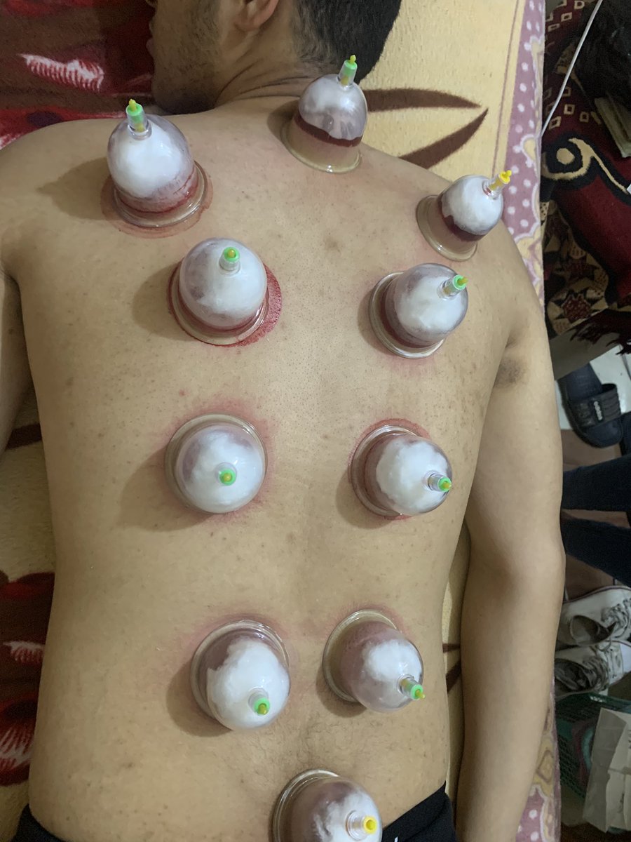 Dr_Sab3's tweet photo. Cupping Therapy Done By Me ❤️👌🏻 
هسيب دول هنا 😂❤️👌🏻 https://t.co/aqQzUsGbfC