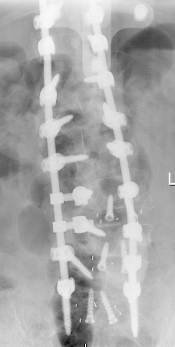 Reconstructing Complex Open Back Wounds with a Modified Minimal-Access Keystone Flap

ow.ly/kdu930rs33U