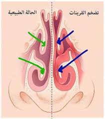 القرنيات الأنفية (Nasal Turbinates)

هي رفوف من العظم مغلّفة بأنسجة رخوة غنية بالشعيرات الدموية
توجد على جدار الأنف الجانبي الداخلي. 
توجد ثلاثة قرنيات في كل جهة من الأنف السفلية (أكبرهم حجماً) و الوسطى و العلوية