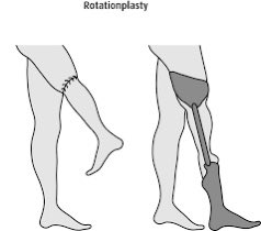 DShadowgazer's tweet photo. just your intermittent reminder that the “rotationplasty” is a real procedure and that medicine is very badass and practical https://t.co/5BIle8MMfC