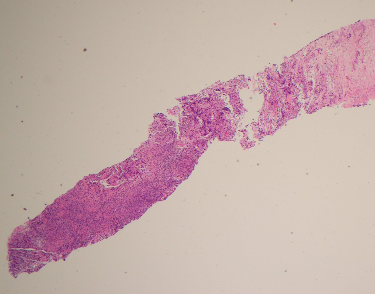 CaDxPath's tweet photo. Pathology is like real estate . . . it's all about position, position, position . .

Core biopsy elderly male

Inflammation (notable for lots of neutrophils) obscures many of the malignant cells

Difficult if anatomical site unknown, fairly straightforward if known

thoughts? https://t.co/syRCboHvl4