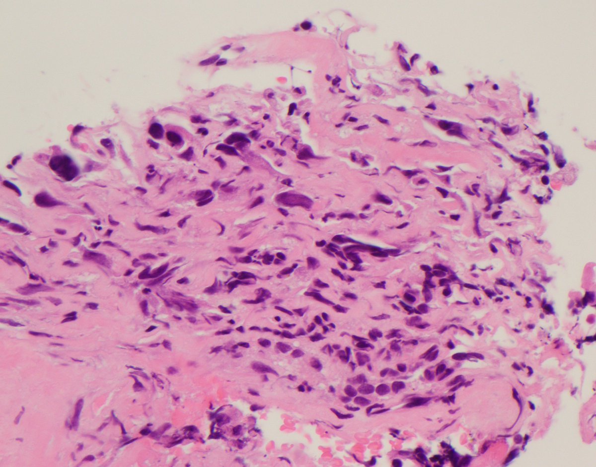 CaDxPath's tweet photo. Pathology is like real estate . . . it's all about position, position, position . .

Core biopsy elderly male

Inflammation (notable for lots of neutrophils) obscures many of the malignant cells

Difficult if anatomical site unknown, fairly straightforward if known

thoughts? https://t.co/syRCboHvl4