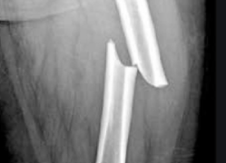 Bisphosphonates and atypical fractures - long term treatment and Asian ethnicity appear to be risk factors. See: medsafetyaustralia.com.au/risk-of-atypic…