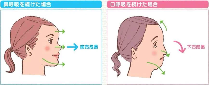 口呼吸を続けた場合の結果が悲惨！悪いことは言わないから鼻呼吸しよう！