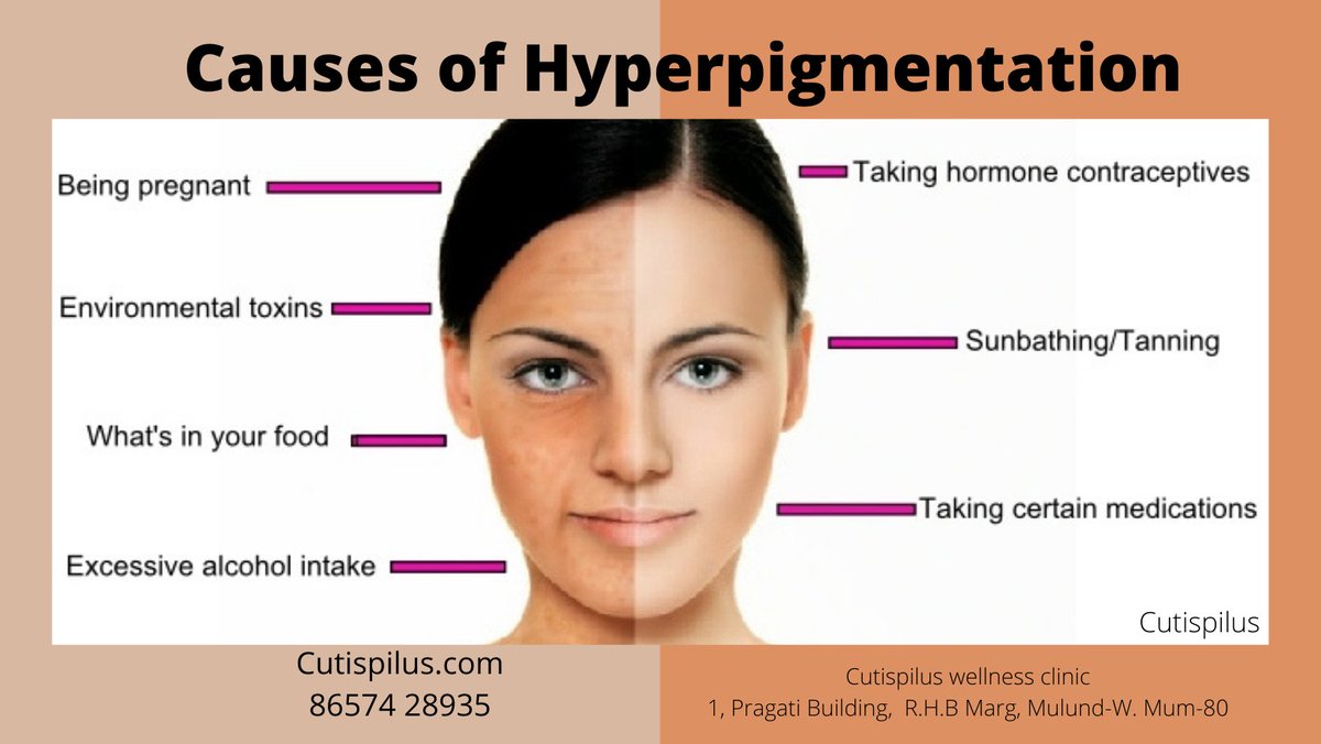 CUTISPILUS's tweet photo. #Hyperpigmentation's characterized by  darkenin of area of #skin caused by d overproductn of a #pigment in d skin known as #melanin. 
Why to Treat? 1. It's relatively common &amp; usually harmless, but 4 cosmetic reasons, it's nuisance.
https://t.co/1BPklUaV5a make 1 tone, even skin. https://t.co/SIA7L5OAAR