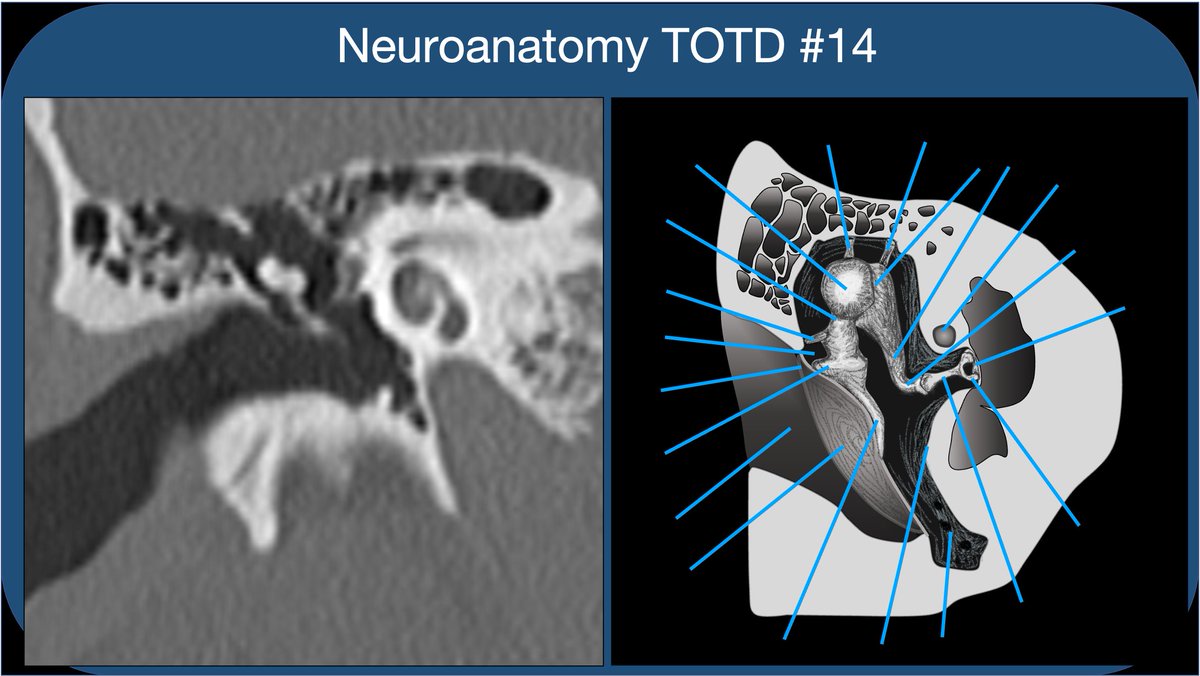 Neuroanatomy TOTD #14🧵 
Got some requests to do one of the trickiest areas of human anatomy, the #temporalbone. So many named structures! #meded #FOAMed #FOAMrad #medtwitter #medstudents #radiology #neurorad #radres #neurosurgery #neuroanatomy #ENT #otolaryngology 

1/21