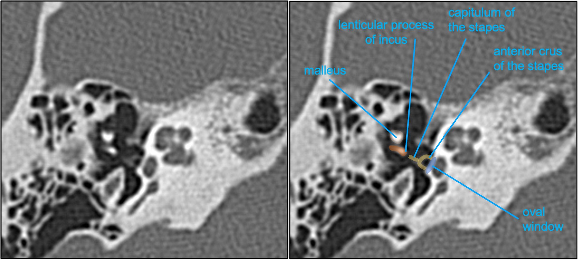 Aaron Rutman, MD on Twitter "The lenticular process articulates w/ the