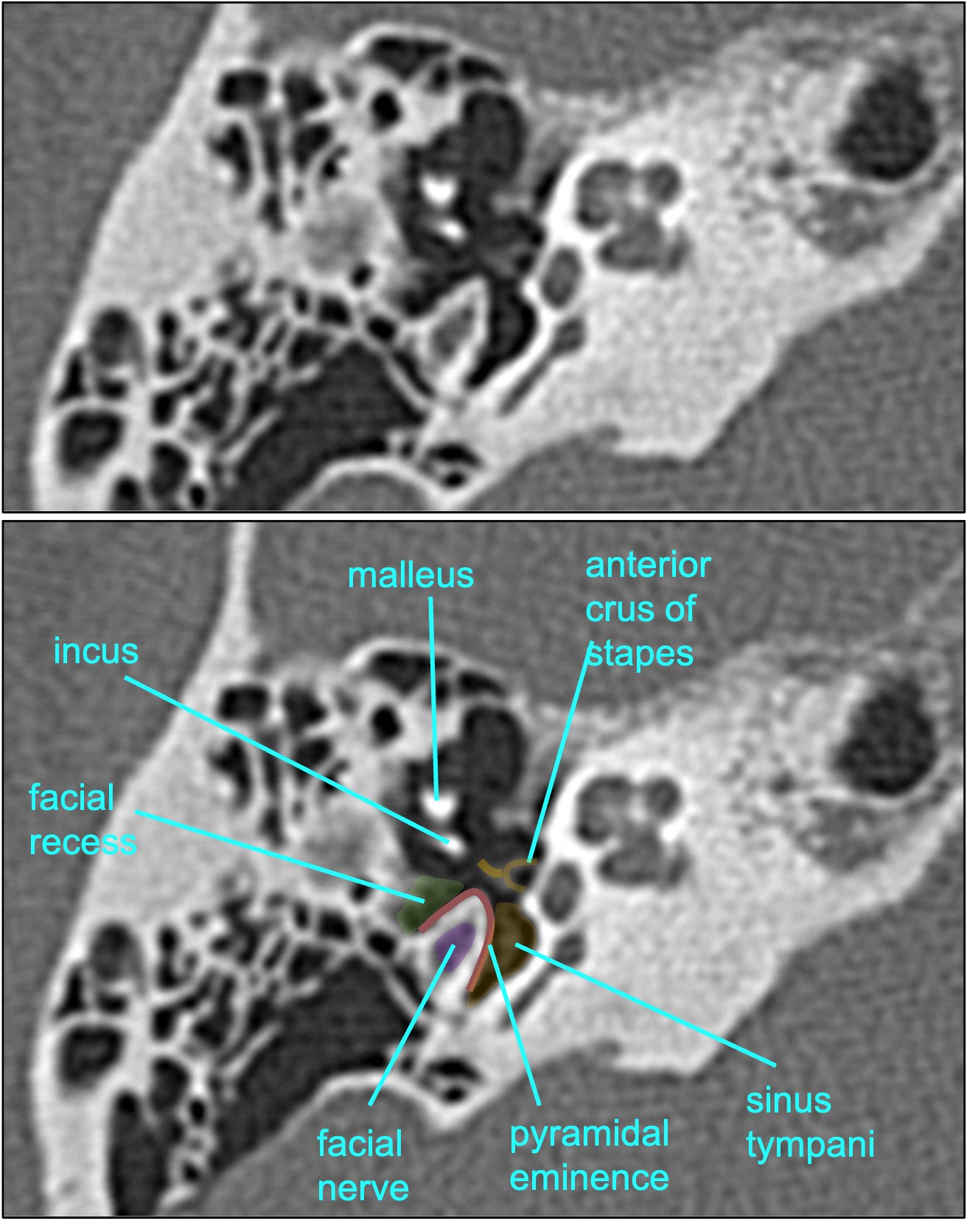 pyramidal eminence ct