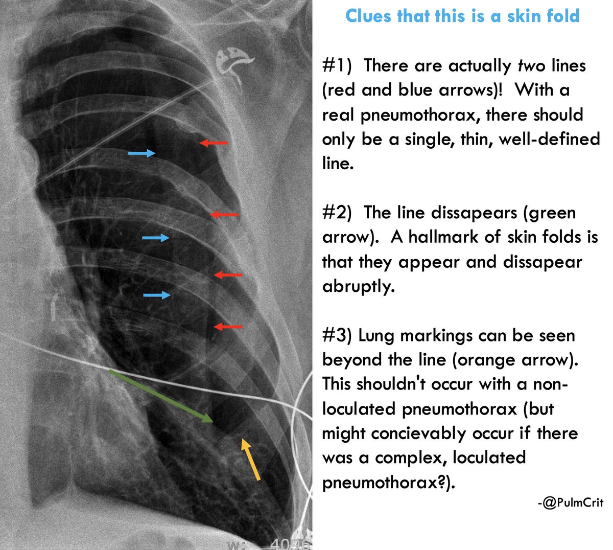 this is actually a skin fold, not a pneumothorax. there are several hints of this on the chest X-ray, but the safest (most idiot-proof) way to sort it out is lung ultrasonography. lung slide on POCUS at several locations on the left chest confidently & immediately excluded PTX