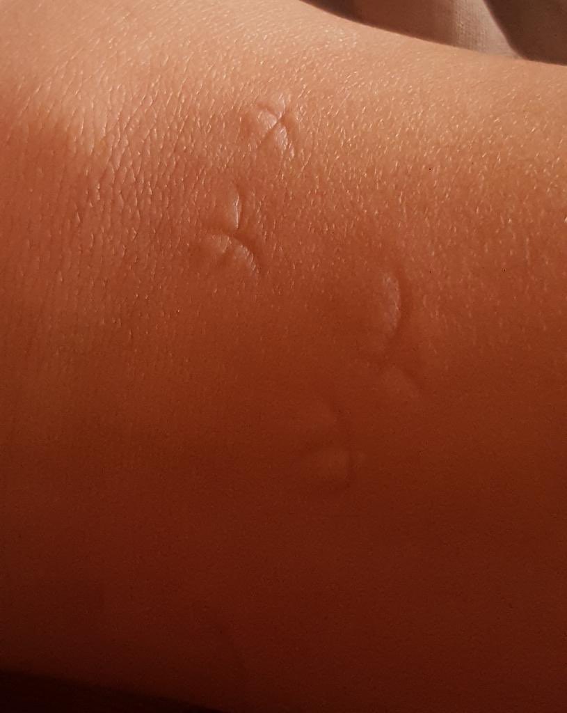 RealBossmann's tweet image. I know I'm not the only who do this if a mosquito bit me.