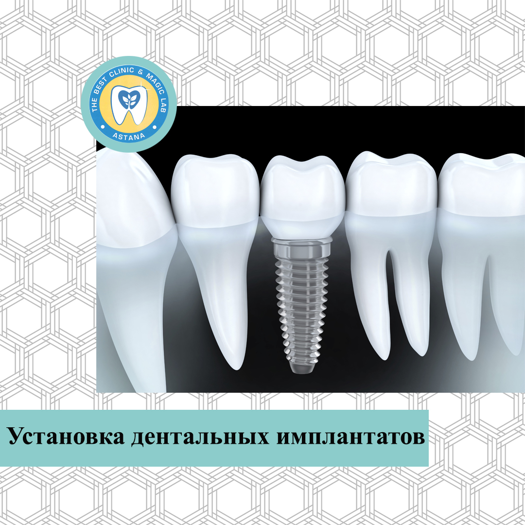 TheBestClinicML's tweet photo. В нашей стоматологической клинике можно поставить импланты при полном отсутствии зубов или при утрате лишь одного элемента зубного ряда. Они полноценно заменяют свои зубы, идеально повторяя их форму и цвет. Пациенты обретают эстетическую привлекательность и уверенность в себе. https://t.co/SOuZjnmcA2