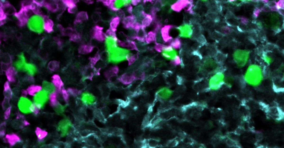 #mdcBerlin researchers have developed a new approach to CAR T-cell therapy. The team shows in <a href="/NatureComms/">Nature Communications</a> that the procedure is very effective, especially when it comes to fighting the most common type of #BloodCancer in adults: mdc-berlin.de/news/press/pot… #leukemia #lymphoma