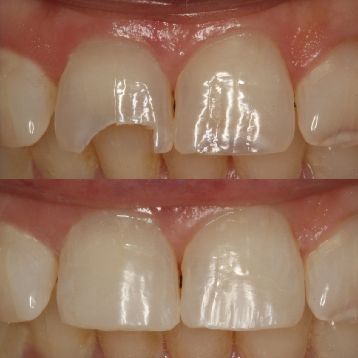WrightsDental's tweet photo. Credit to Dr. Coleman for this astonishing restoration using SimpliShade™, the Simplified Universal Composite System by Kerr.
Request your free Sample at https://t.co/rrXMpezXwE Restorations That Shine. Excellent Radiopacity #wrightsdental #kerrdental #simplishade https://t.co/HYBKOUb65q
