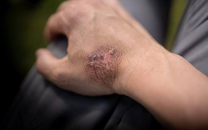 .. such as in burns and ulcers, and an ointment is made with it. It serves for a purge to the lean and irascible, expels bile, and reduces adipose tissue.”