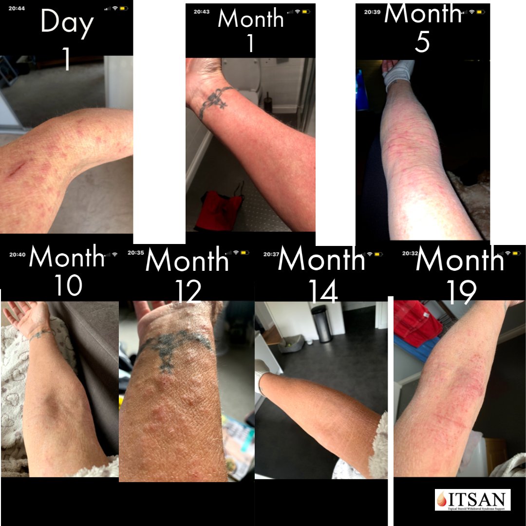 ITSANnonprofit's tweet photo. It often helps to see the bigger picture. Changes are happening every single day for your skin. The hardest moment is temporary in the long run. Let's help each other on the hard parts. Our community deserves to celebrate BIG on the easier parts.
#itsan #togetherweheal #tsws https://t.co/u0AtDNDtOS