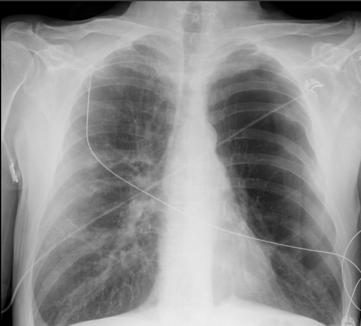 you're managing a new admission who is relatively undifferentiated (presenting with hypotension, hypoxemia, and altered mental status). the radiology tech wheels out of the room and shows you this film. what is your next move? (#1/4)