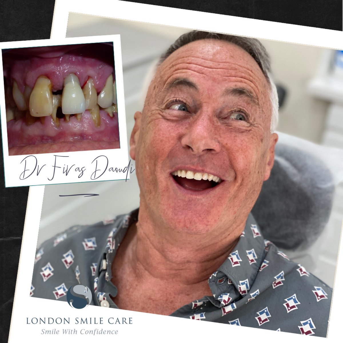 LondonSmileCare's tweet photo. #dentalimplants can be life changing experience. If you are suffering with #missingteeth #brokenteeth or #dentures problem, we can help. 
Send us DM, 📧 or ☎️ 
Our #specialistdentist will be happy to help.
#Londondentist
 #Singlevisitdentistry #digitalsmiledesign https://t.co/qCo5DAJKdh