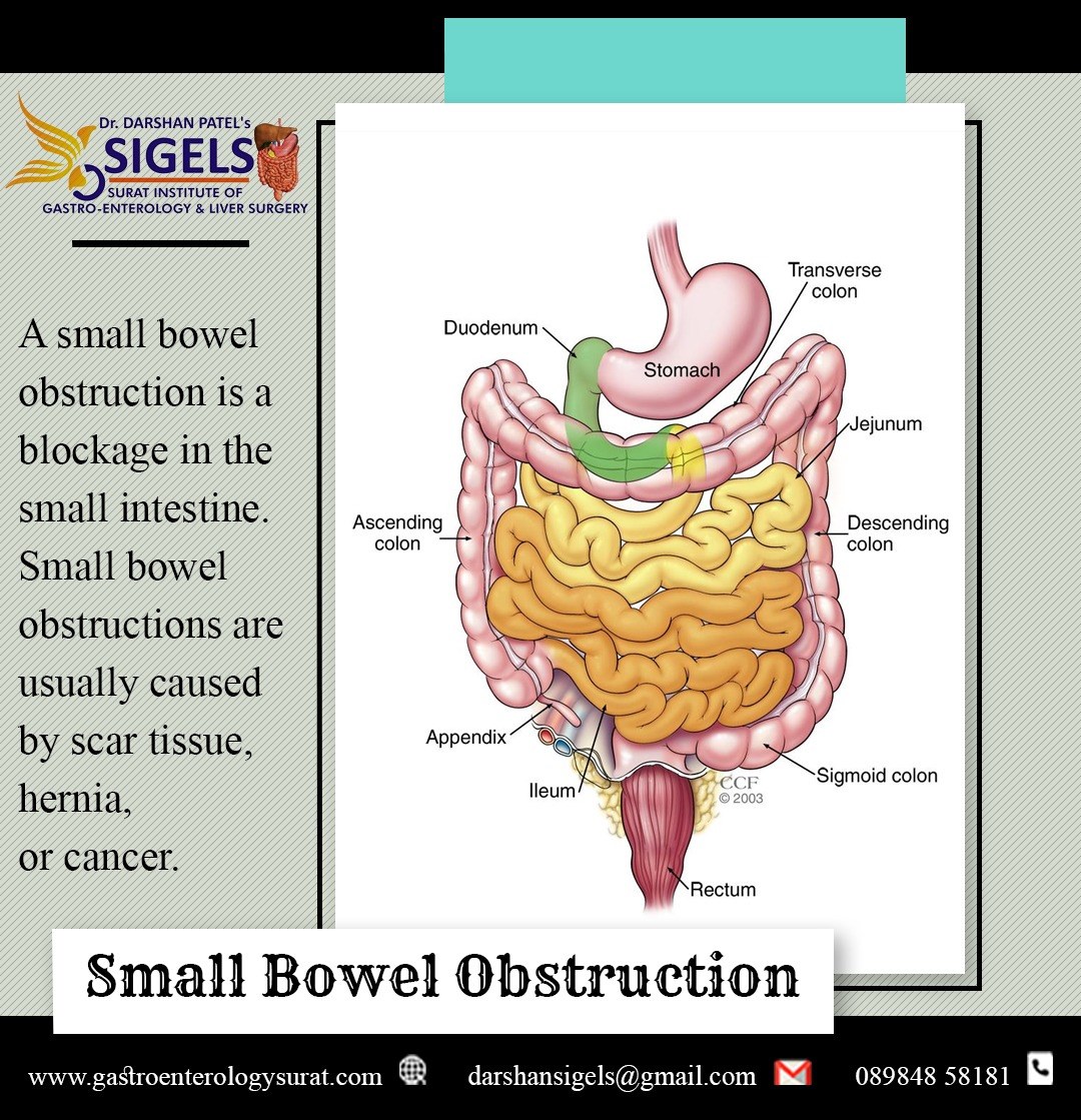 Small Bowel Obstruction:-

A small bowel obstruction is a blockage in the small intestine. Small bowel obstructions are usually caused by scar tissue, hernia, or cancer.

Call us: +91-89848-58181
or visit website: gastroenterologysurat.com

#SmallBowelObstruction