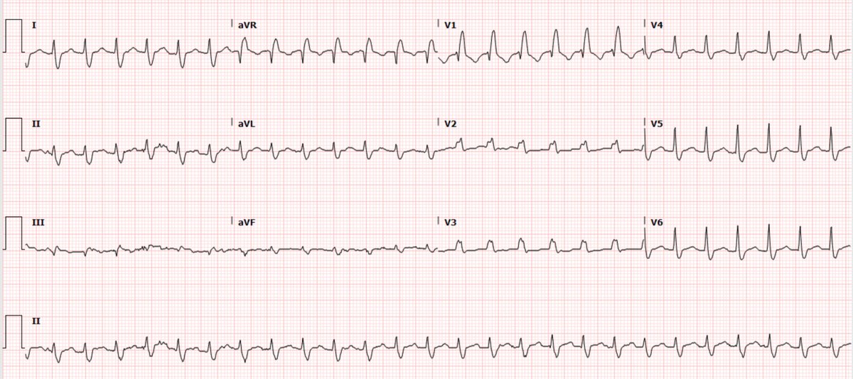 smithECGBlog's tweet photo. A wide complex tachycardia

https://t.co/ZucQcOU7UG https://t.co/JctiJ3kISm