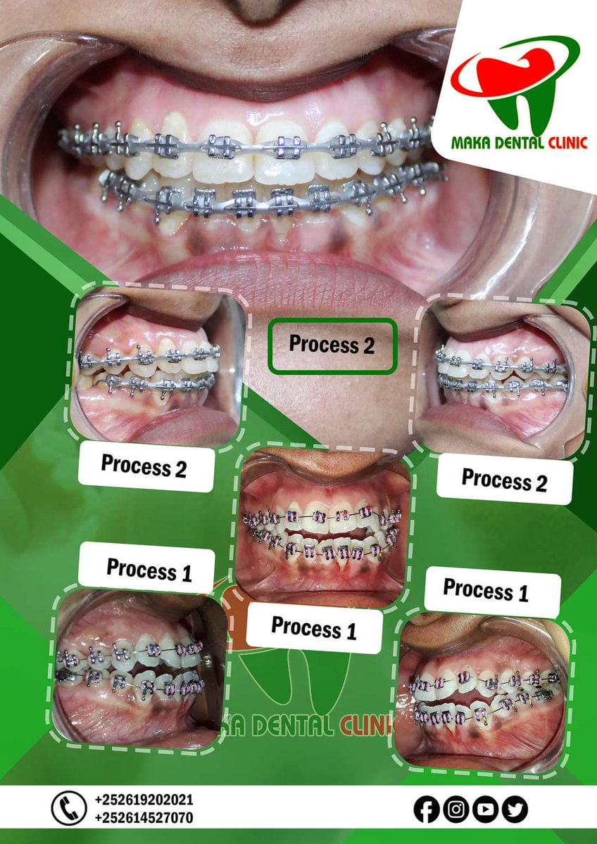 MAKADENTALCLIN1's tweet photo. Hadii aad isleedahay ilkaheygu iima hagaagayaan, kuna welwel santahay natiijadaada, Qarashkuna wuu igu badanyahay aad is leedahay, taasi Maankaaga kasaroo #Maka_Dental
#Whatsp: +252615512168   +252615123993  +252616573027 https://t.co/dUzUJl31Re