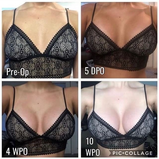 PLASTIC SURGERY CONSULTANT on X: Before I even show my breast , I need you  all to understand the “dropping and fluffing process “ Please read. / X