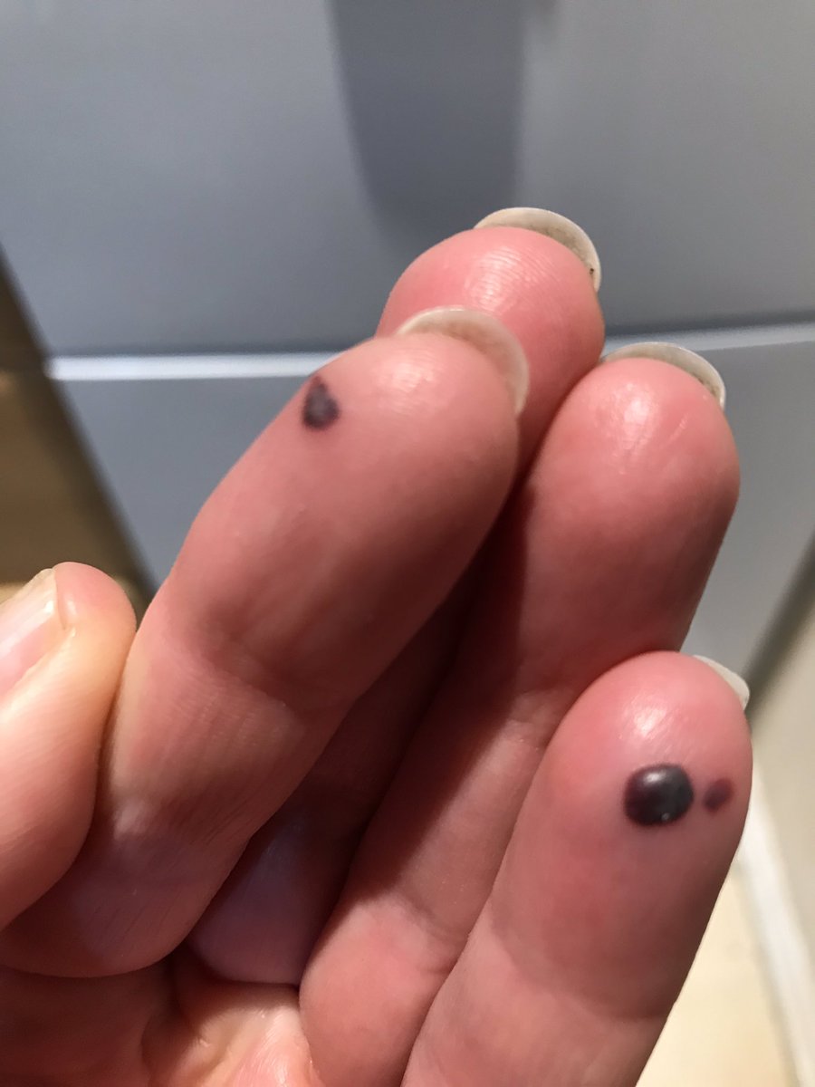 vintagechairs's tweet photo. Today’s war wounds from the workshop. I probably shouldn’t be allowed in there 😂 #lockdownworking https://t.co/6pXanJkBHQ