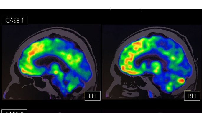 4/5 He would state repeatedly: “I do not have feelings because I am dead.” He said that he had a “right-sided” heart & that it had stopped. A brain 18F-FDG PET study revealed prominent hypometabolism in the right occipito-parietal cortex,more accentuated in the right hemisphere.