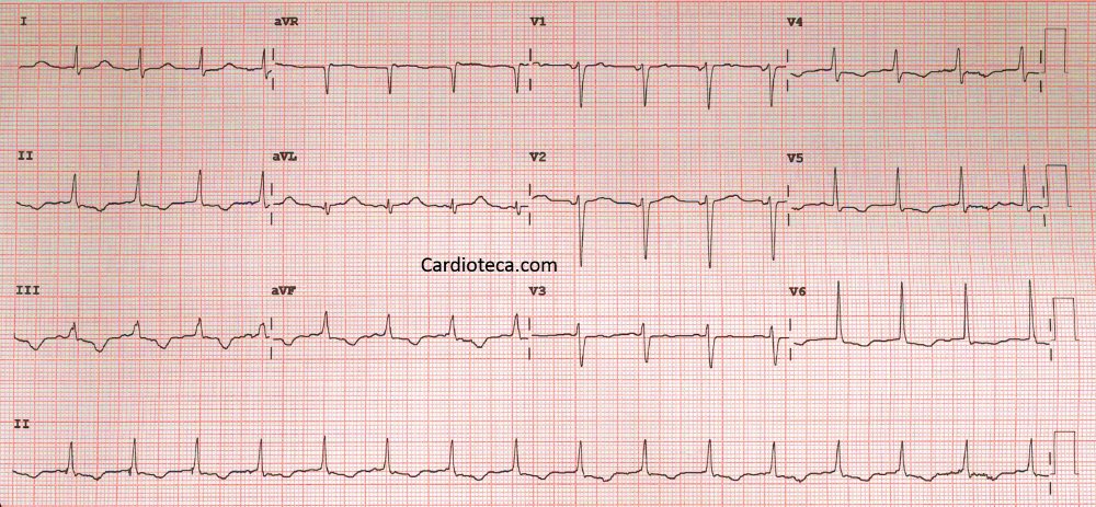 cardioteca's tweet photo. #ECGCardioTeca 405 - 80 años, marcapasos por FA lenta (última revisión: 94% latidos estimulados por marcapasos -94%VP-), acude por su 1er episodio de IC.
🧐¿Adivinas el diagnóstico? https://t.co/45kWU7xxw6
@ESTEVE_news nos acompaña en el Aula de ECG este año! 🤗
#ecg #cardiologia https://t.co/HY1S6tbcTv